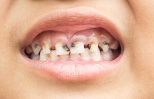  علائم پوسیدگی دندان 