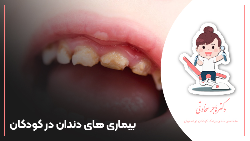 بیماری های دندان در کودکان