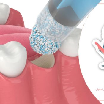 پیوند پودر استخوان دندان برای کودکان