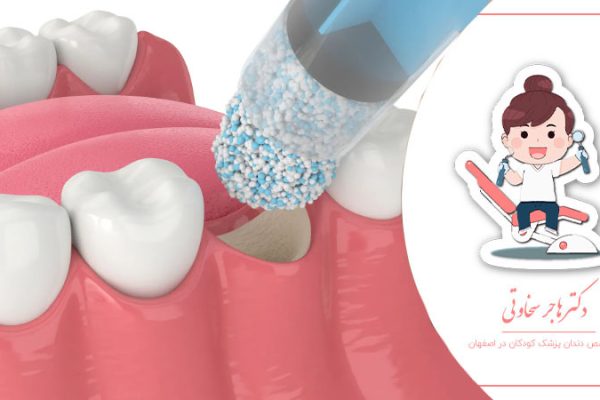 پیوند پودر استخوان دندان برای کودکان