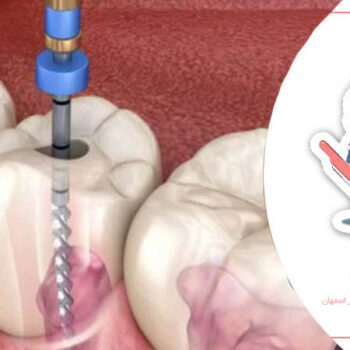 پرکردن و عصب کشی دندان