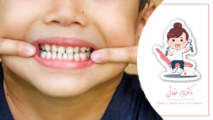 پوسیدگی دندان شیری: علل و درمان