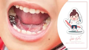 مواد پرکننده مناسب برای دندانهای شیری