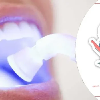 لیزر دندانپزشکی برای درمان دندان کودکان