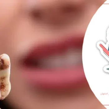 درمان پوسیدگی دندان شیری