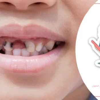 تاثیر شیرینی بر سلامت دندان کودک