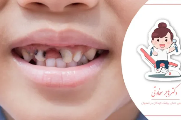 تاثیر شیرینی بر سلامت دندان کودک