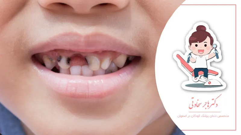 تاثیر شیرینی بر سلامت دندان کودک