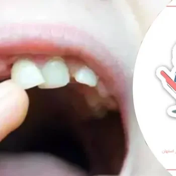 آیا کشیدن دندان شیری دردناک است