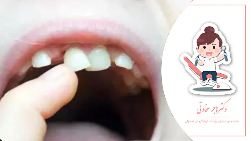 آیا کشیدن دندان شیری دردناک است