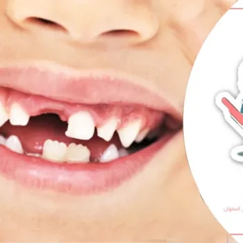 نکات طلایی برای مراقبت از دندان‌های شیری