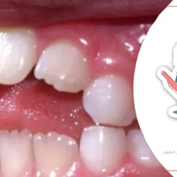 تأثیر عادات غلط بر رشد فک و دندان