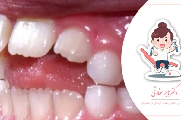 تأثیر عادات غلط بر رشد فک و دندان