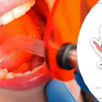 روش‌های نوین ترمیم دندان‌های شیری
