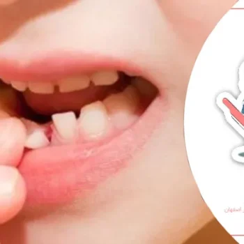 چه زمانی دندان‌های کودکان نیاز به پر کردن دارند؟