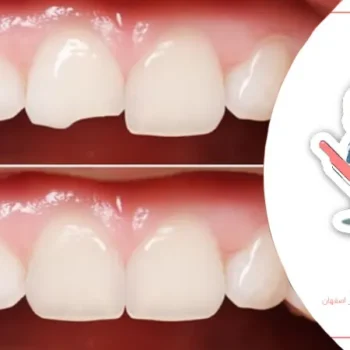 چگونه با شکستگی دندان کودک برخورد کنیم