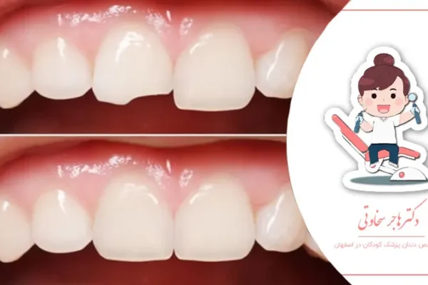 چگونه با شکستگی دندان کودک برخورد کنیم