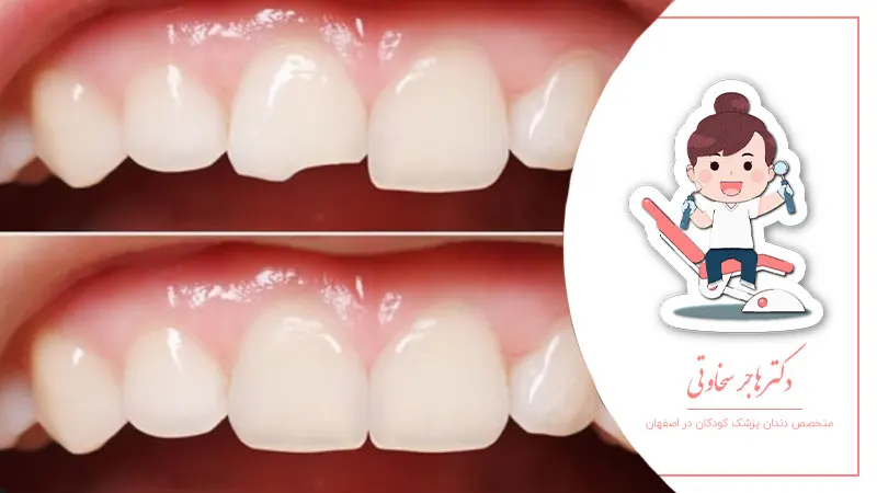 چگونه با شکستگی دندان کودک برخورد کنیم