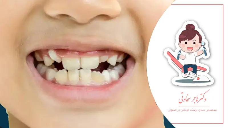 دلایل نامرتبی دندانها در کودکان