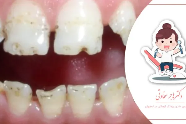 چرا مینای دندان کودکان آسیب‌پذیرتر است؟