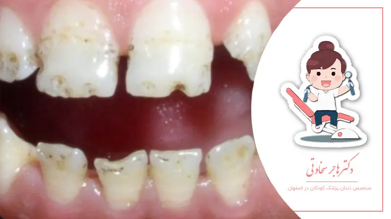 چرا مینای دندان کودکان آسیبپذیرتر است؟