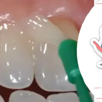 تاثیر مواد فلورایددار بر سلامت دهان کودک