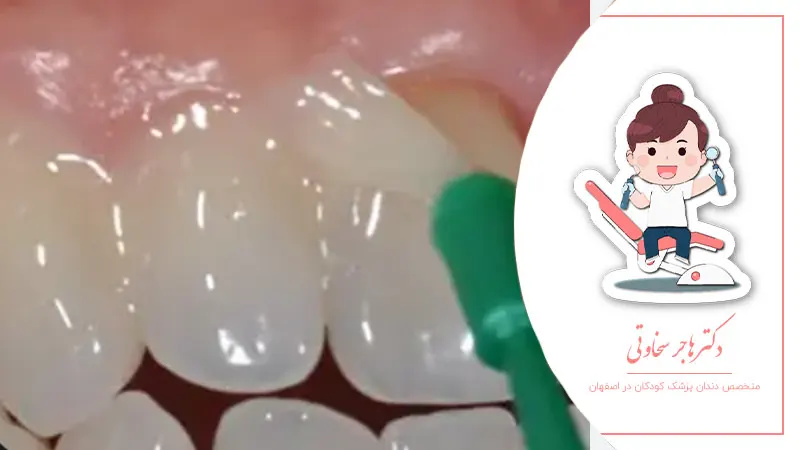 تاثیر مواد فلورایددار بر سلامت دهان کودک